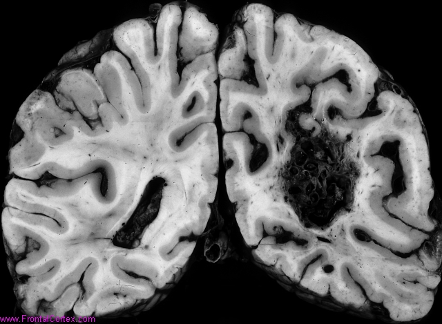 Arteriovenous malformation, with draining vein (superior)